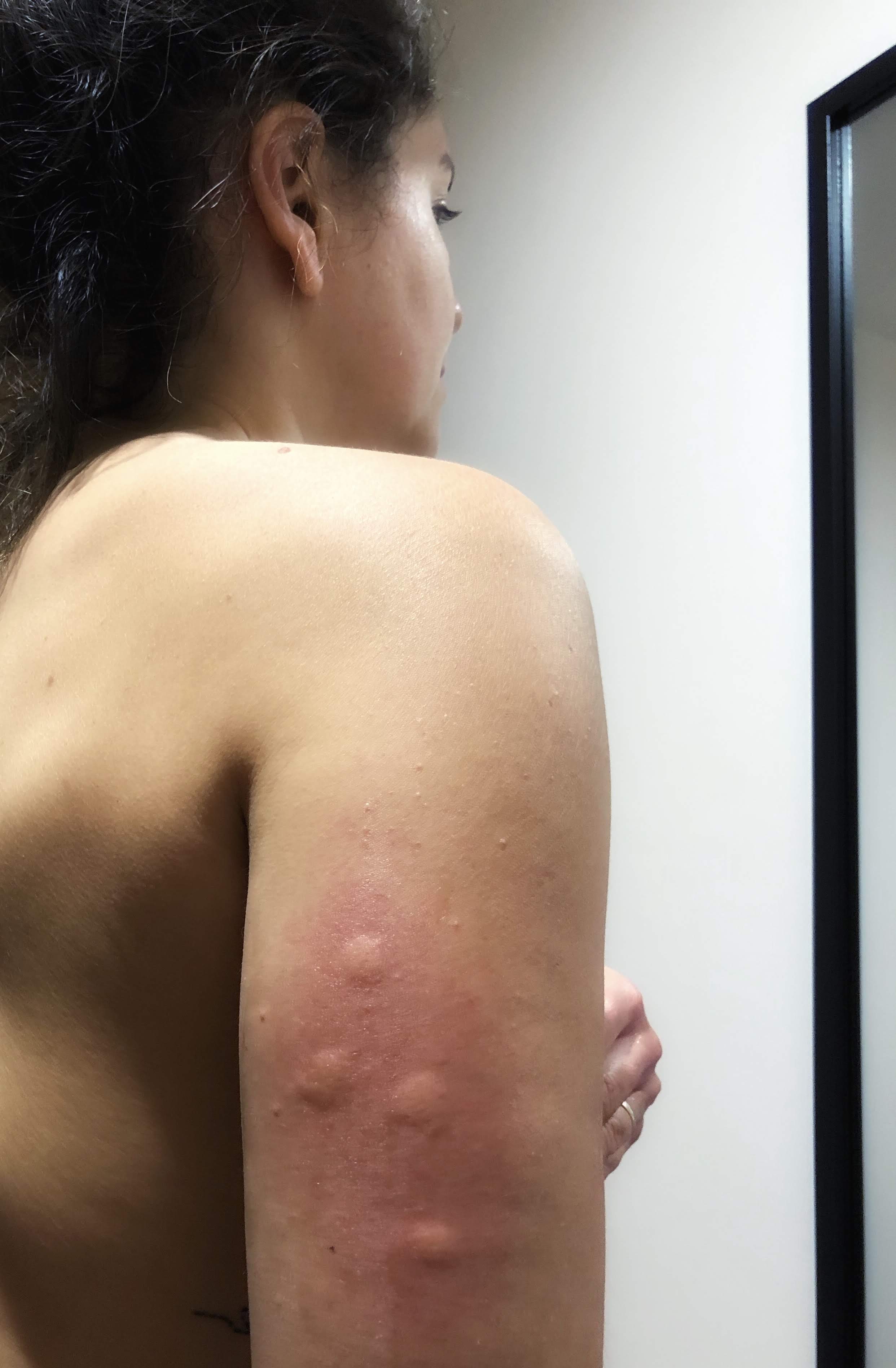 Veja O Que Fazer Quando For Atacada Por Percevejos Ou Bed Bugs